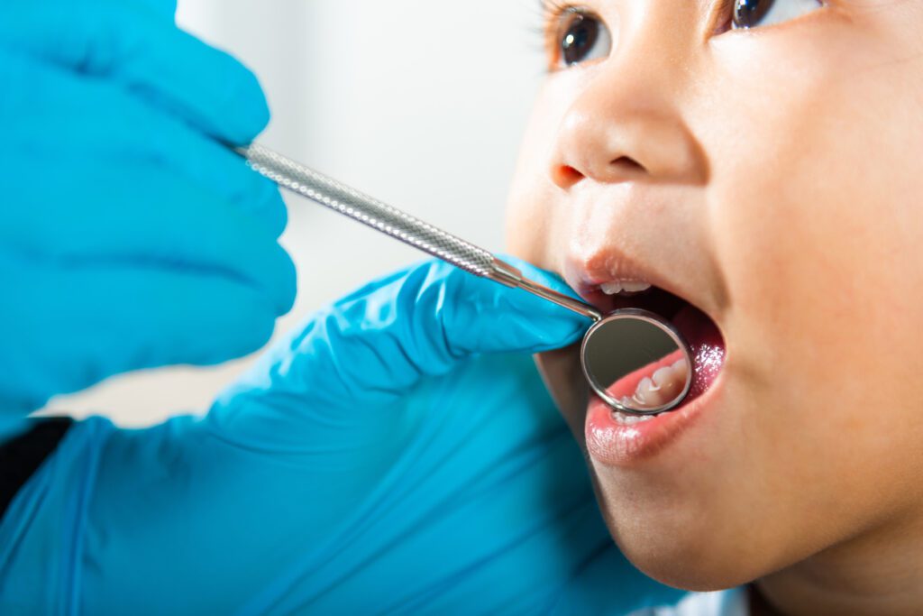 Open-mouthed child undergoing a dental examination.